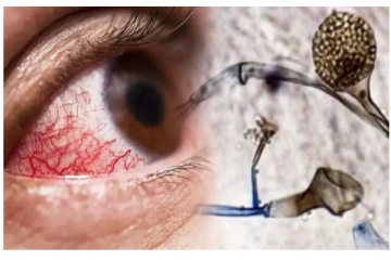 இந்தியாவில் இதுவரை கருப்பு பூஞ்சை நோயால் 219 பேர் உயிரிழப்பு - வெளியான அதிர்ச்சி தகவல்!