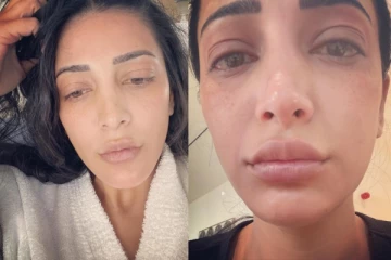 ஸ்ருதிஹாசன் முகத்துக்கு என்னாச்சு.. புகைப்படத்தால் ரசிகர்கள் அதிர்ச்சி!