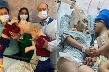 33 மணி நேர அறுவை சிகிச்சை .. தலை ஒட்டி பிறந்த  குழந்தைகளை பிரித்து மருத்துவர்கள் சாதனை