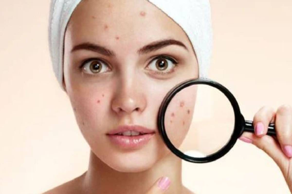 முகத்தில் கரும்புள்ளியா? பின்னால் உள்ள உடல்நல எச்சரிக்கை என்ன தெரியுமா? | The Health Warning Behind Dark Spots முகத்தில் கரும்புள்ளியா? பின்னால் உள்ள உடல்நல எச்சரிக்கை என்ன தெரியுமா? | The Health Warning Behind Dark Spots