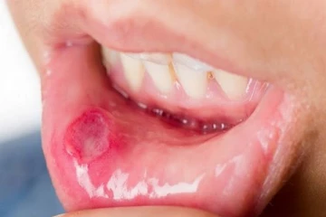 வாய்ப்புண்ணால் பெரும் அவஸ்தையா? இதனை போக்க இதோ சில டிப்ஸ்!