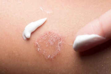 நாட்டின் பல பகுதிகளில் பரவும் தோல் நோய்