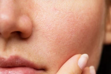 உங்க முகத்தில் சருமத் துளைகள் பெருசு பெருசா இருக்கா? இதனை எப்படி போக்க இதோ சில சூப்பரான டிப்ஸ்!