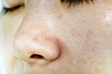 மூக்கில் இருக்கும் அசிங்கமான வெண்புள்ளிகளைப் போக்க வேண்டுமா?