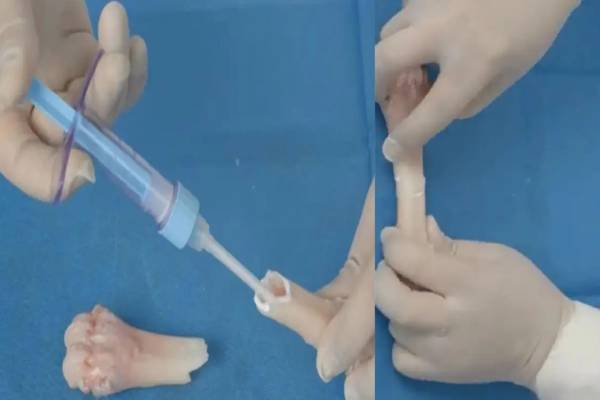 bone fracture fixing glue