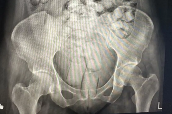 விமான நிலையத்தில் கைது செய்யப்பட்ட இளம்பெண்கள்: எக்ஸ்ரேயில் தெரிந்த அதிர்ச்சி காட்சி | Breaking Two Women Caught Smuggling
