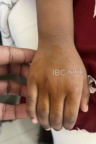 மானிப்பாய் பிரதேச சபையின் பொறுப்பேற்ற செயல்: சிறுமியின் கையை பதம் பார்த்த குரங்கு | Monkey Injures Girl At Jaffna Park