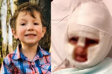 பந்தில் பெட்ரோலை ஊற்றி தீவைத்து சிறுவன் மீது வீச்சு: வாழ்நாளுக்கும் மறையாத வடுக்களுடன் பாதிப்பு