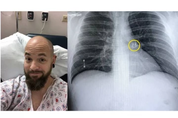 5 ஆண்டுக்கு முன் தொலைந்த மூக்கு வளையம் - ஸ்கேன் செய்து பார்த்த மருத்துவர்களுக்கு காத்திருந்த அதிர்ச்சி!