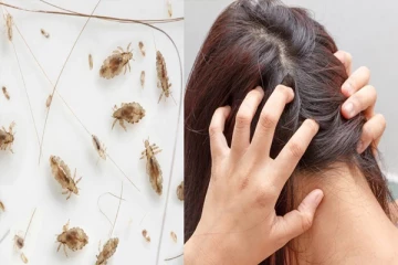 பேன் தொல்லை உங்களை பாடாய்படுத்தி எடுக்குதா? அதனை நீக்க இயற்கை முறைகள்