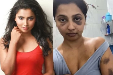 கொடூரமாக தாக்கிய முன்னாள் காதலன் - கதறிய நடிகை அனிகா