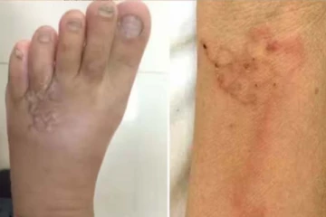 பெண்ணின் தோலுக்கடையில் இருந்த புழுக்கள்... மூளைக்கும் சென்ற சோகம்! நடந்தது என்ன?