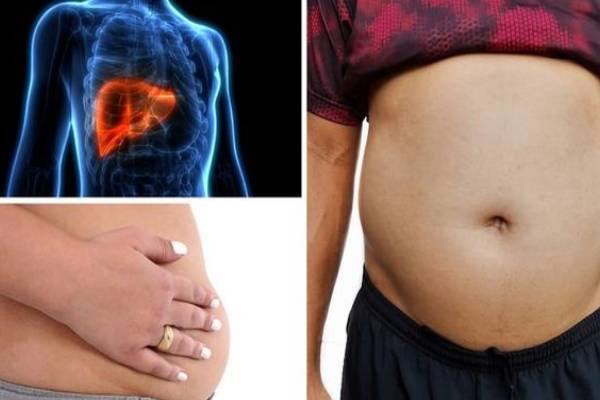 வயிறு வீக்கம்.. கல்லீரல் பாதிப்பின் தீவிரம்- இனியும் தாமதம் வேண்டாம்! | Does Liver Disease Cause A Swollen Stomach