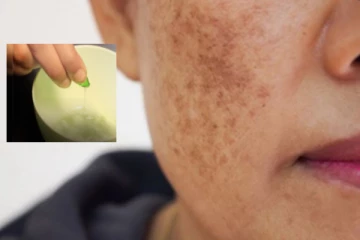 முகத்தில் உள்ள கரும்புள்ளிகள் நீங்க வேண்டுமா? இரவில் வைட்டமின்-இ உடன் இதை தடவுங்க