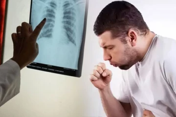 இரத்தினபுரி மாவட்டத்தில் காச நோய் அபாயம்