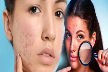 முகப்பருவால் வந்த தழும்புகள் மாற வேண்டுமா? தினம் இந்த ஒரு பழம் போதும்