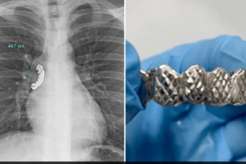 வெள்ளி பற்களை விழுங்கிய இளைஞர்: உயிரை காப்பாற்ற மருத்துவர்கள் மேற்கொண்ட சிகிச்சை