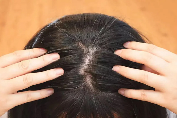 முடி உதிர்விற்கான காரணமும் தடுக்கும் முறைகளும் | Hair Loss Causes And Prevention Methods