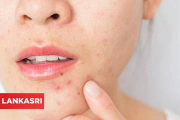 முகத்தை பாழாக்கும் பருவினால் உணடாகும் பிரச்சனைகளை தீர்க்க வேண்டுமா? இதோ டிப்ஸ்