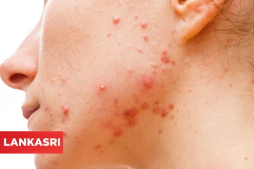 கன்னத்தில் பரு வர என்ன காரணம்? இதனை எப்படி போக்கலாம்?