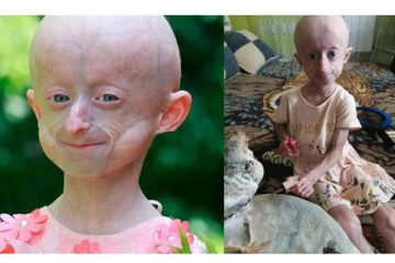 10 வயதில் 80 வயது தோற்றம் - அரியவகை நோயால் பாதிக்க சிறுமி மரணம்!