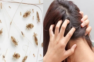 பேன் தொல்லை அதிகமாக இருக்கின்றதா?