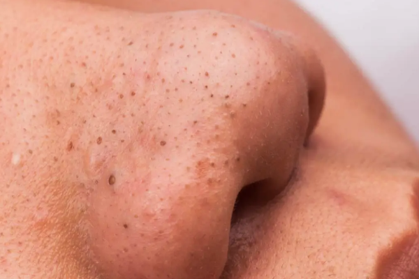 முகத்தின் விடாப்பிடியான கரும்புள்ளியை எப்படி இயற்கையாக நீங்குவது? | How To Remove Dark Spots Naturally