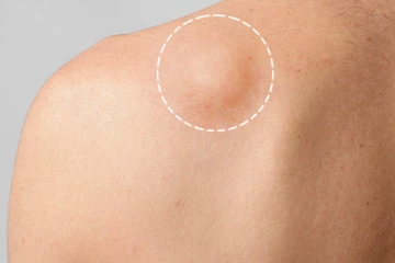 அவஸ்தை தரும் கொழுப்பு கட்டிகளை கரைய வைக்க வேண்டுமா? இதோ எளிய வழிமுறைகள்