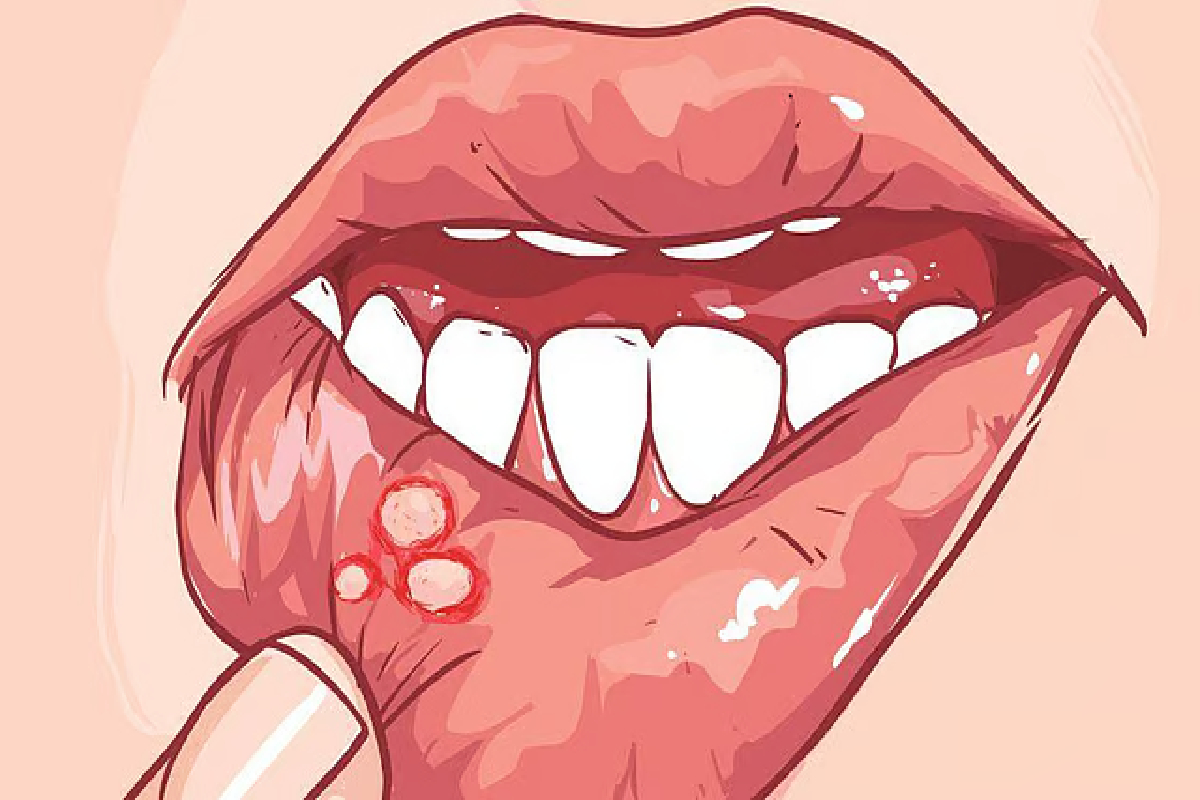 அடிக்கடி வாயில் புண் வந்தால்.. அது புற்றுநோயின் அறிகுறியா? | Get Frequent Mouth Ulcers Is That A Sign Of Cancer