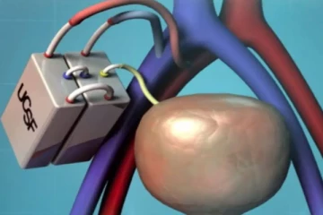 செயற்கை சிறுநீரகத்தை உருவாக்கிய விஞ்ஞானிகள்