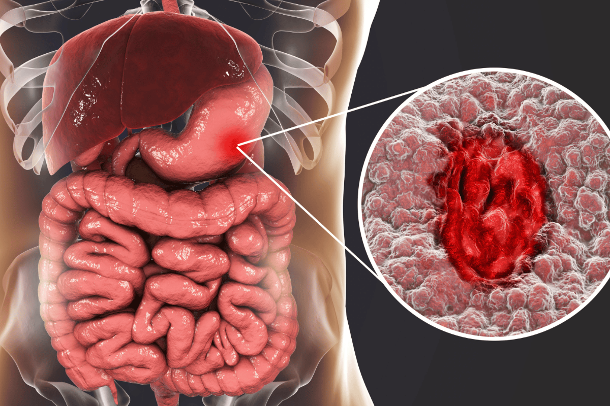 Stomach Ulcer: வயிற்று புண்கள் ஏற்படுவதற்கு முக்கியமான காரணம் | Reason For Stomach Ulcer How To Prevent It Stomach Ulcer: வயிற்று புண்கள் ஏற்படுவதற்கு முக்கியமான காரணம் | Reason For Stomach Ulcer How To Prevent It
