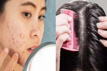 தலையில் பொடுகு இருந்தால் முகப்பரு வருமா? இரண்டுக்கும் ஒரே வைத்தியம் இது தான்