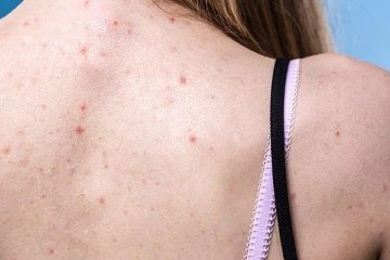 முதுகெல்லாம் முகப்பருவா இருக்கா? இதனை எப்படி எளியமுறையில் போக்கலாம் தெரியுமா?