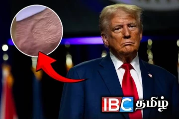 ட்ரம்பிற்கு அரியவகை நோய் : வெளியான அதிர்ச்சித் தகவல்