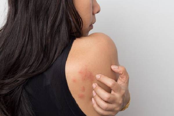 Red Spots on Skin: சருமத்தில் தோன்றும் சிவப்பு புள்ளிகள் ஆபத்தானதா? மருத்துவ விளக்கம் | Whats The Reson Behaind Red Spots On Skin