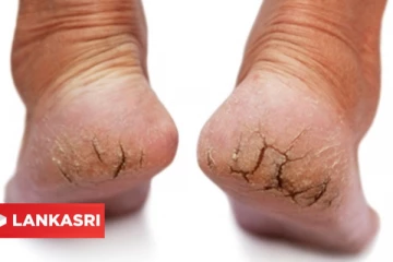 அசிங்கமாக இருக்கும் குதிகால் வெடிப்பை போக்க வேண்டுமா? இதோ சூப்பரான வழிமுறைகள்