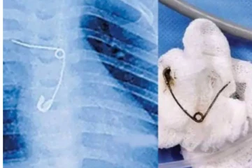 வலியால் துடித்த 8 மாத குழந்தை - சுவாச குழாயில் சிக்கியிருந்த ஊக்கை அகற்றிய மருத்துவர்கள்