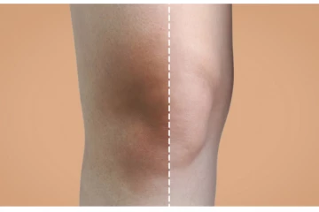 முழங்கால் அழகை கெடுக்கும் கருமை - வீட்டு வைத்தியம் மூலம் தடுப்பது எப்படி?