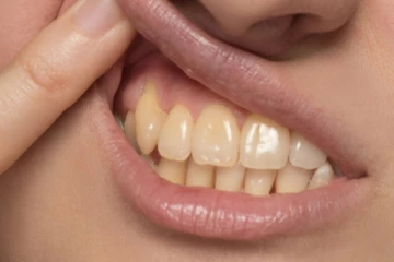 பற்கள் மஞ்சளாக நிறமாக மாற காரணம் என்ன? இதனை எப்படி போக்கலாம்?