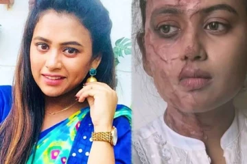 பாரதி கண்ணம்மா சீரியல் புகழ் பரீனாவிற்கு என்ன ஆனது?- முகமெல்லாம் தழும்பாக உள்ளதே?