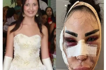 ’கிம்’ போல மாறனும்.. 4 கோடி செலவு பண்ணி 40 தடவ ஆபரேஷன் - வசமாக மாட்டிய பெண்!