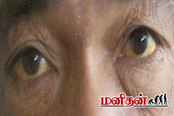 மஞ்சள் காமாலை நோய்: மருத்துவரின் விரிவான விளக்கம் | Jaundice About Full Details In Tamil