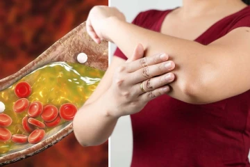 இந்த அறிகுறிகள் இருக்கா? உடம்புல கொலஸ்ட்ரால் அதிகரித்துவிட்டது...உடனே மருத்துவரை நாடுங்கள்