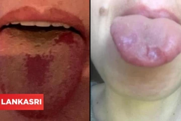 புதிதாக கண்டுபிடிக்கப்பட்டுள்ள ஒரு கொரோனா அறிகுறி... கவனம் செலுத்த வலியுறுத்தும் பிரித்தானிய மருத்துவர்