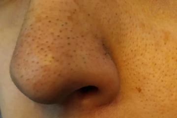 மூக்குக்கு மேல் உள்ள அசிங்கமான கரும்புள்ளியை நீக்க வேண்டுமா?