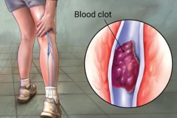 රුධිර කැටියක් ඇති බව හඟවන පූර්ව රෝග ලක්ෂණ.