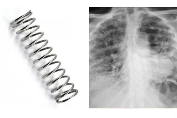 நுரையீரலுக்குள் இருந்த Metal Spring..சளிக்காக மருத்துவமனைக்கு சென்ற பெண்ணுக்கு நேர்ந்த கதி!