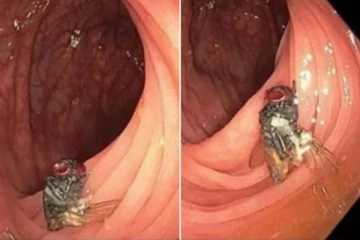 குடல் பரிசோதனைக்காக மருத்துவரிடம் சென்ற அமெரிக்கர்: கமெராவில் சிக்கிய அதிரவைக்கும் காட்சி...