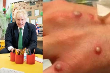 பிரித்தானியாவில் மூன்று மடங்காக அதிகரித்த monkeypox தொற்றாளர்கள்: ஒரே நாளில் 36 பேர்களுக்கு உறுதி