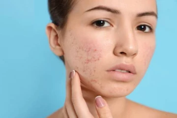 இயற்கை முறையில் முகப்பருக்களை தடுப்பது எப்படி?